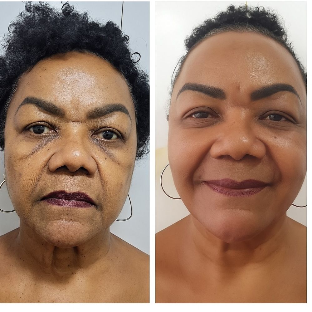 Clareamento de Manchas